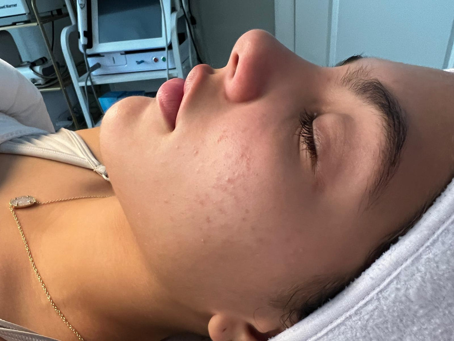 Acne facials