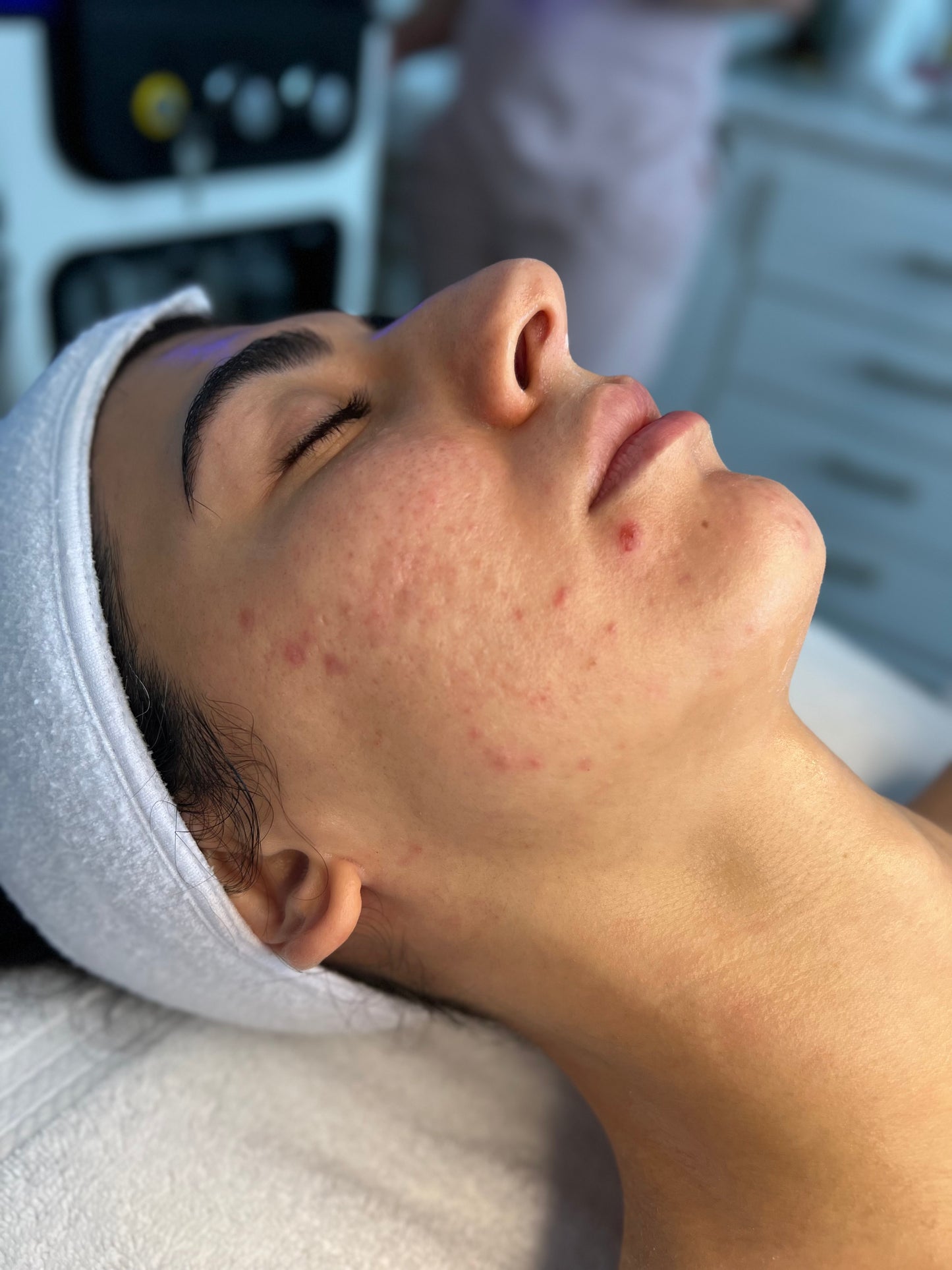 Acne facials