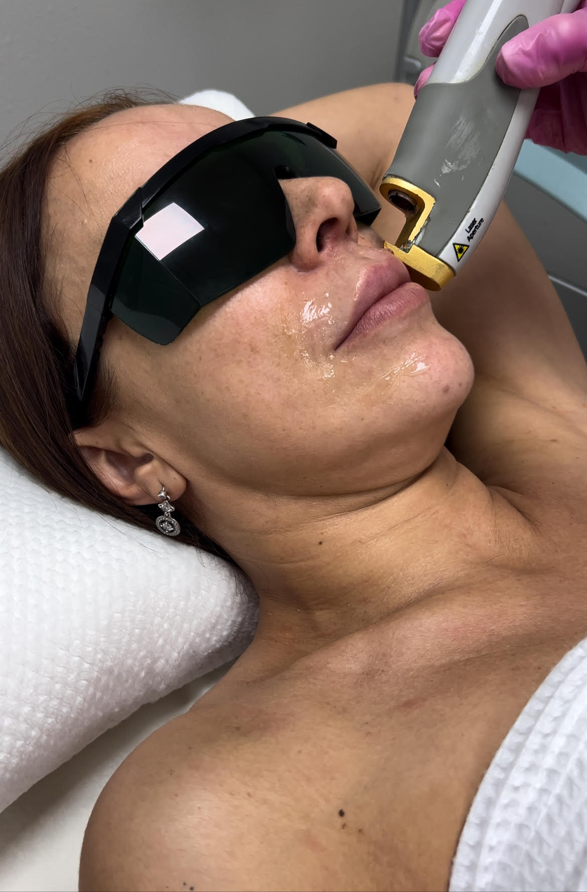 Upper Lip Laser