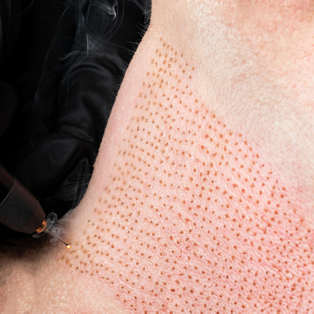 Plasma Fibroblast Armpit