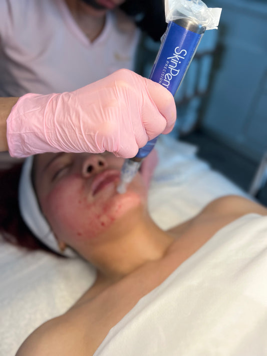 SkinPen with Filorga