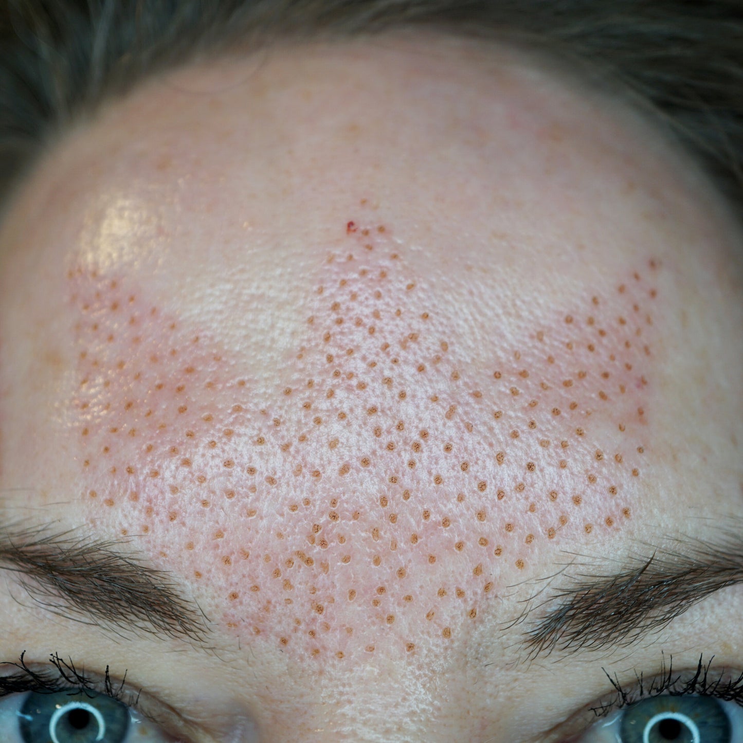 Plasma Fibroblast Forehead
