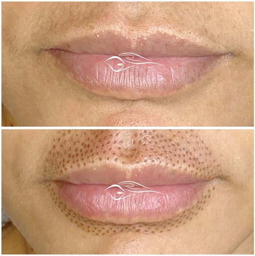 Plasma Fibroblast Full Lip Area